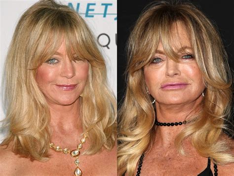 goldie hawn cosmetic surgery